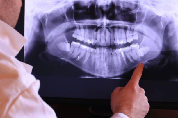 Best Broken or Cracked Tooth Emergency Dentist in Cupertino, CA