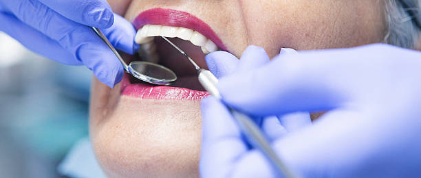 Best Emergency Dentist for Lost Fillings or Crowns in Cupertino, CA